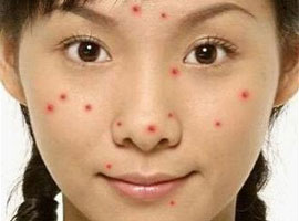 长痘痘的部位分析