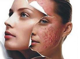 彻底祛除红色痘印 你需要做到这几点