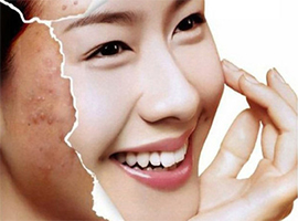 痘痘怎么祛除？ 5招彻底赶走痘痘君