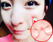 痤疮要怎么去除?无暇肌肤调理秘密公开