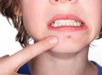 维生素E可以去痘?玛尚教你靠谱祛痘!