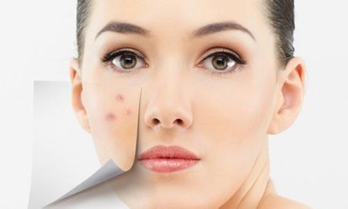 科普：为啥有的人不长痘，有的人却频繁的长?